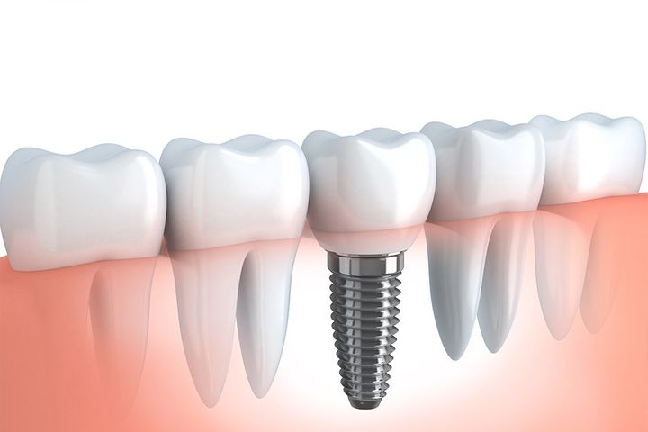 dental implants